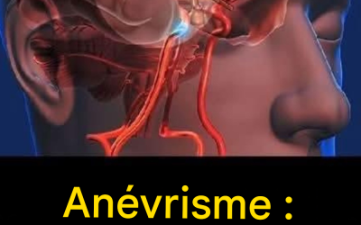 Anévrisme : signes à ne pas ignorer…