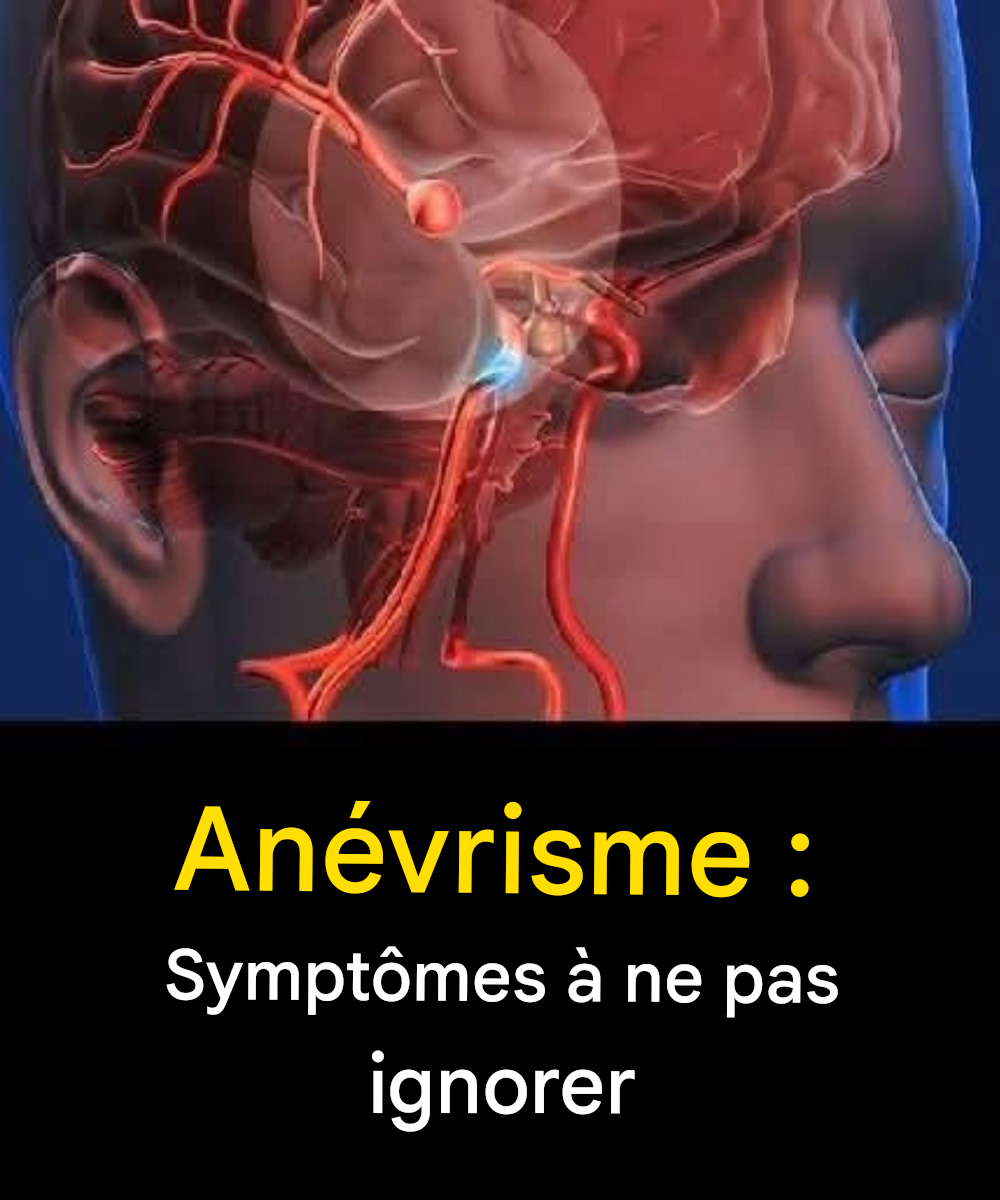 Anévrisme : signes à ne pas ignorer…