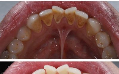 7 astuces pour se débarrasser des taches de tartre disgracieuses avec presque 0 travail.