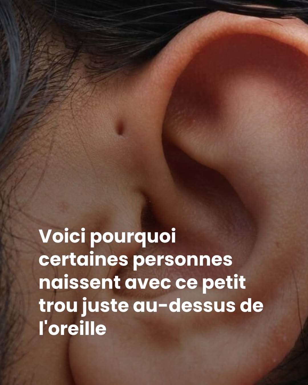 Voici pourquoi certaines personnes naissent avec ce petit trou juste au-dessus de l’oreille ?