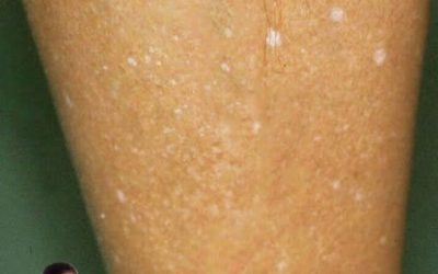 REMÈDES MAISON POUR TRAITER LES INFECTIONS FONGIQUES DE LA PEAU
