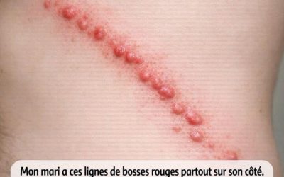Mon mari a des lignes de petits boutons rouges sur tout le côté. Ça le démange énormément et ça a l’air enflammé. On a peur d’une infection. Qu’est-ce que c’est ?
