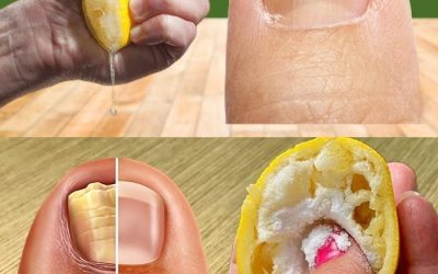 Dites adieu aux mycoses tenaces des ongles des pieds grâce à ce remède naturel