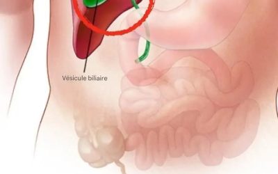 Que se passe-t-il dans le corps après une ablation de la vésicule biliaire ? 3 maladies qui peuvent survenir Évitez la chirurgie si possible