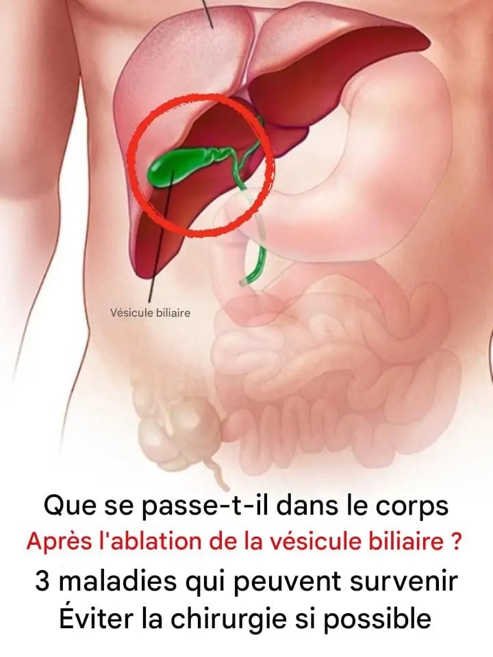 Que se passe-t-il dans le corps après une ablation de la vésicule biliaire ? 3 maladies qui peuvent survenir Évitez la chirurgie si possible