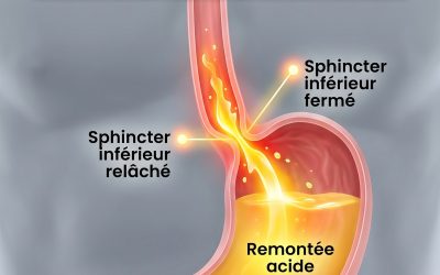 3 façons d’arrêter le reflux acide naturellement