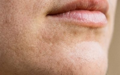 Les poils du menton d’une femme sont un signe de…Voir plus