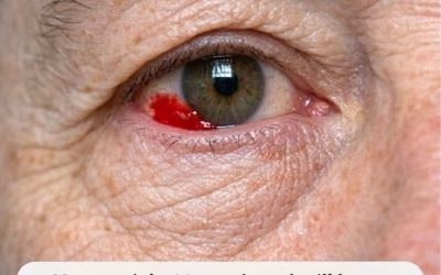 Mon mari de 64 ans s’est réveillé avec une tache rouge sang sur l’œil Devons-nous aller à l’hôpital ?