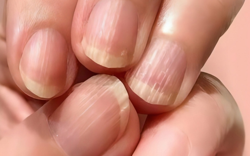 Ce que vos ongles disent de votre santé
