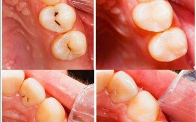 Caries : causes et remèdes naturels