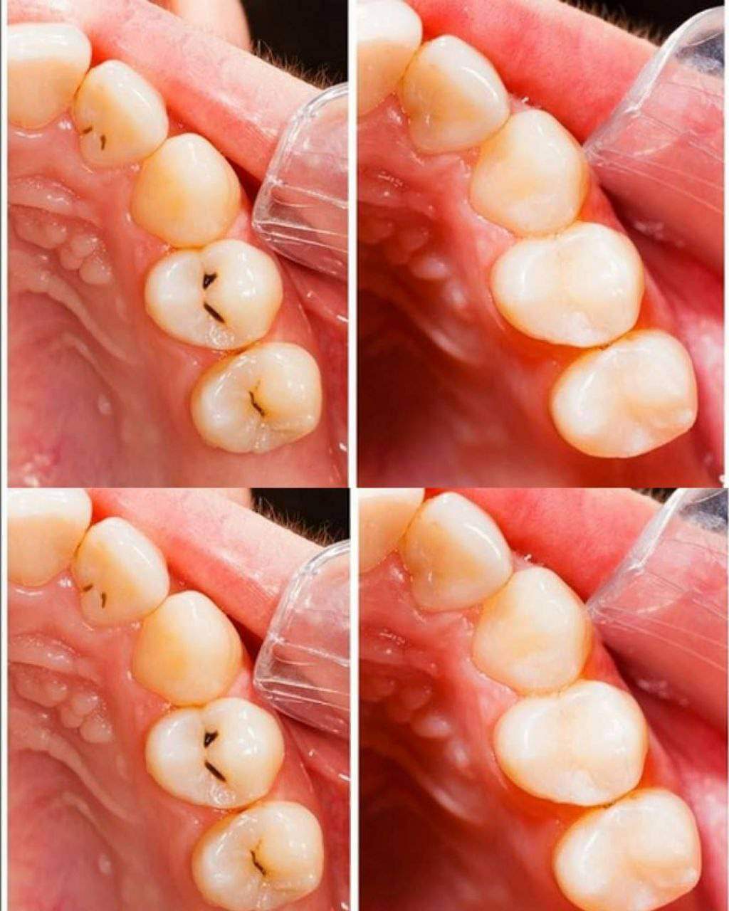 Caries : causes et remèdes naturels