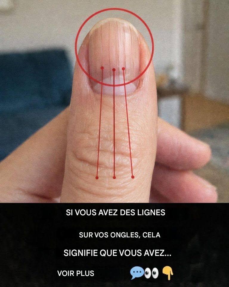 Lignes des ongles : ce qu’elles peuvent révéler sur votre santé