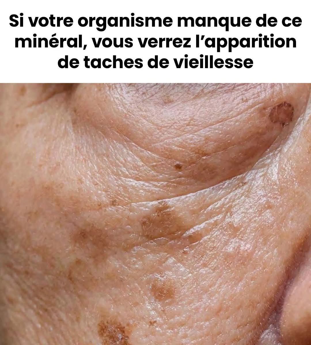 Si ce minéral vient à manquer, le risque de voir apparaître des taches de vieillesse augmente