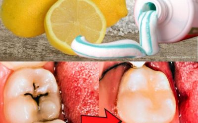 Comment guérir une carie naturellement (et ce que personne ne vous dit…)