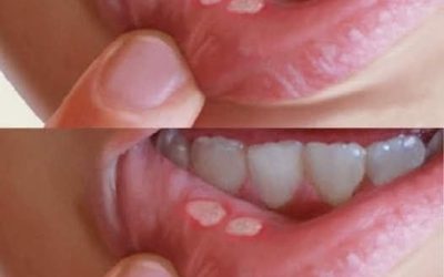 Aphtes : comment s’en débarrasser naturellement en quelques minutes.