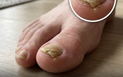 Deux maladies silencieuses que vos pieds peuvent révéler : les signes à repérer et quand consulter
