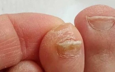 L’astuce pour diminuer l’épaisseur des ongles de pied