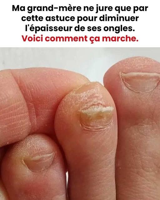 L’astuce pour diminuer l’épaisseur des ongles de pied