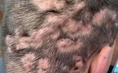 Une vidéo choquante d’une tête infestée de poux dans le bus fait le tour des réseaux sociaux