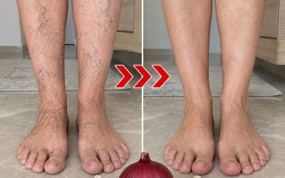 Le remède naturel qui réduit les varices et améliore la circulation en quelques semaines