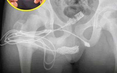 Un jeune homme a été transporté d’urgence à l’hôpital après s’être retrouvé avec un câble USB coincé dans l’urètre : il essayait de mesurer son pénis et le câble s’est emmêlé