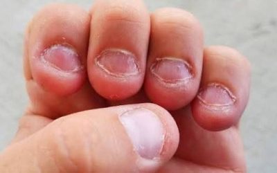 Se ronger les ongles : découvrez pourquoi et comment se débarrasser définitivement de cette habitude.