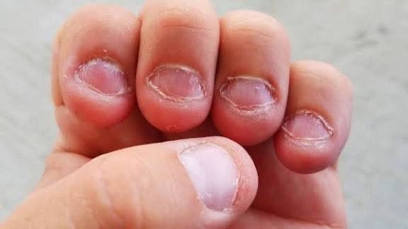 Se ronger les ongles : découvrez pourquoi et comment se débarrasser définitivement de cette habitude.