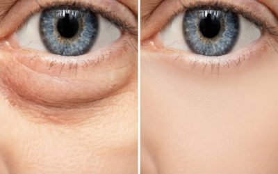 Un ingrédient de cuisine pour éliminer les yeux gonflés rapidement