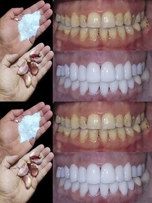Comment blanchir les dents en 2 minutes?