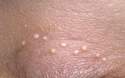 J’ai des petits boutons blancs sur les paupières et je n’ai pas encore pu consulter. De quoi s’agit-il ?… LIRE LA SUITE