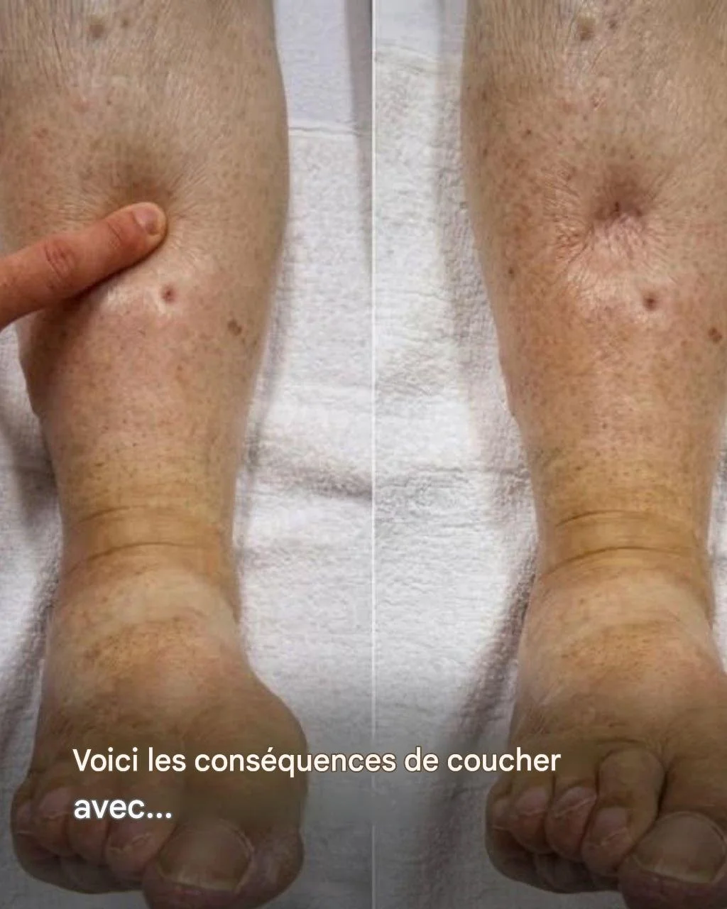 Maladie de Charcot : voici les premiers symptômes de cette maladie