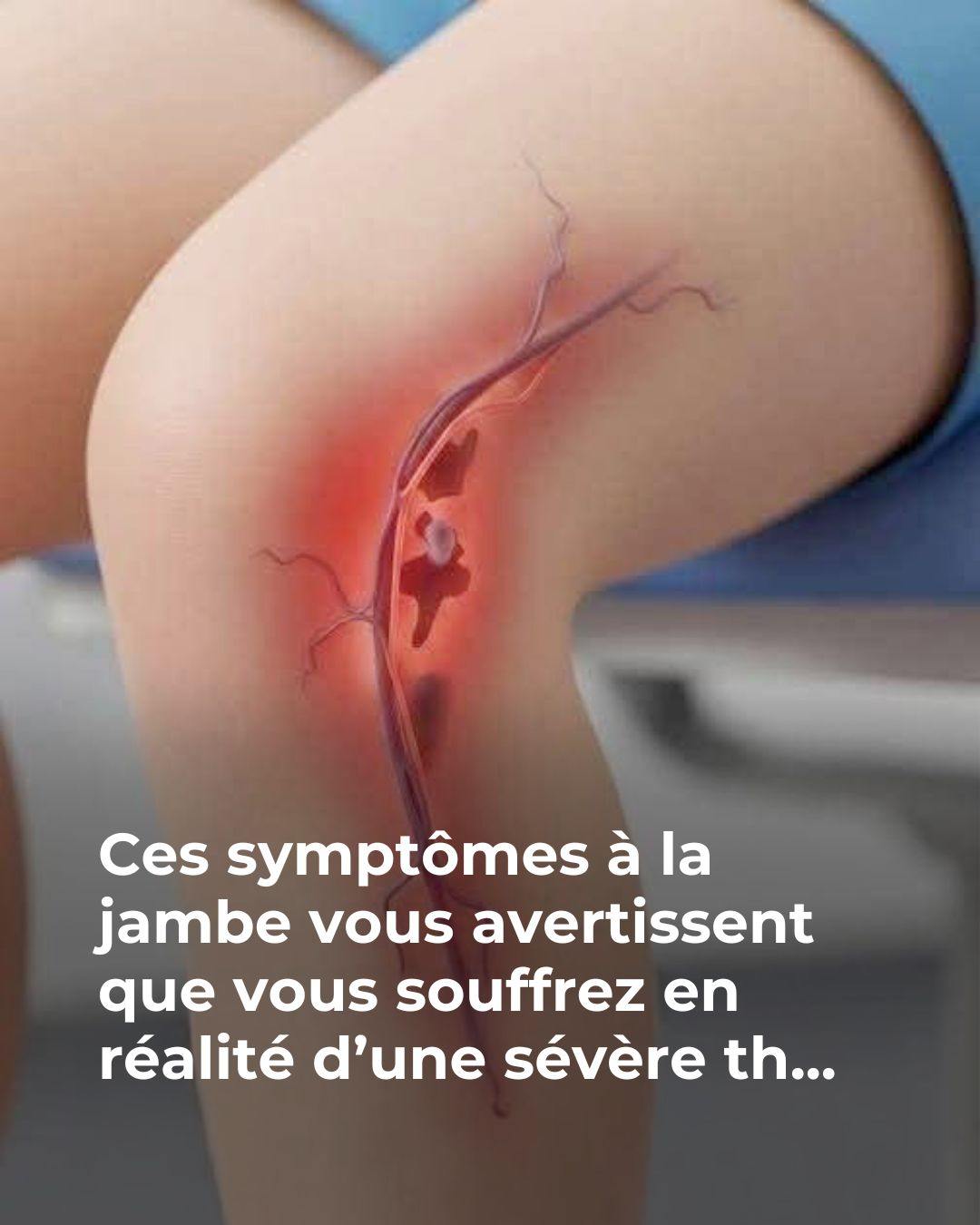 Symptômes qui vous avertissent d’une thrombose sévère…Voir plus