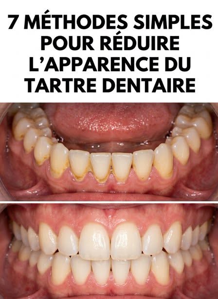 7 secrets naturels pour dire adieu aux dépôts de tartre sur les dents
