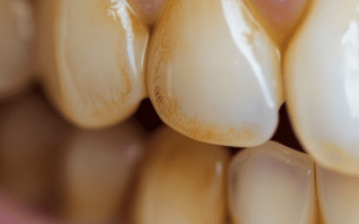 Les dentistes ne vous diront pas ceci : des moyens naturels d’enlever le tartre et de blanchir les dents à la maison