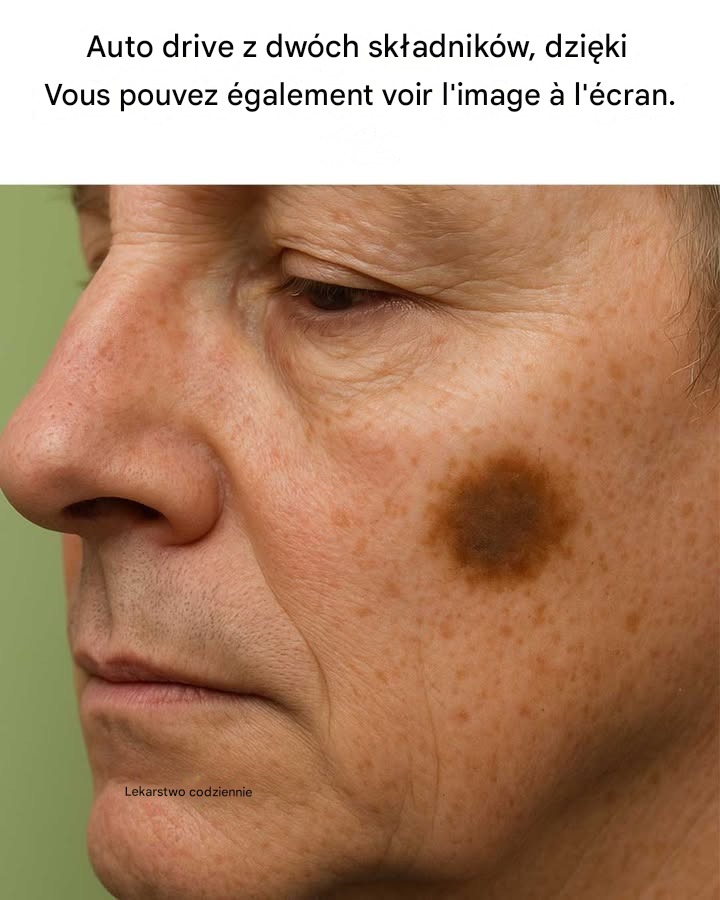 Voici une astuce à deux ingrédients pour vous débarrasser des taches brunes sur votre peau.