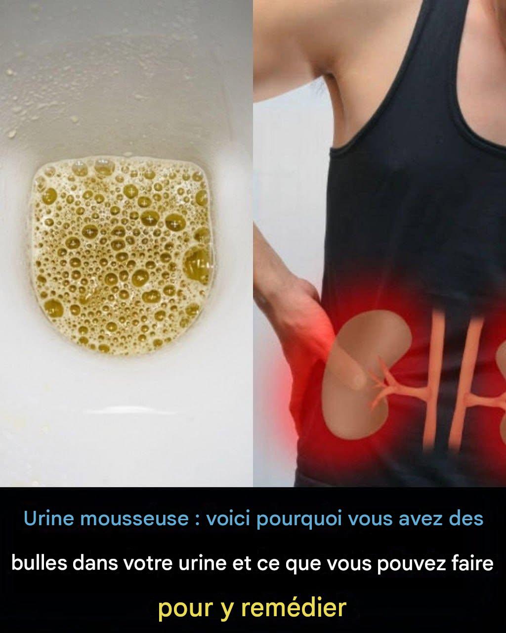Urine mousseuse : voici pourquoi vous pourriez remarquer des bulles dans votre urine