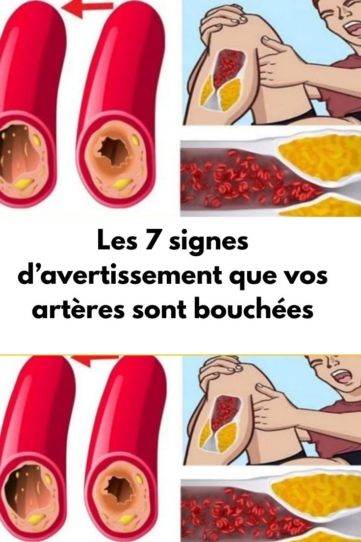 Les 7 signes d’avertissement que vos artères sont bouchées.